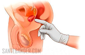 traitement de la dysérection