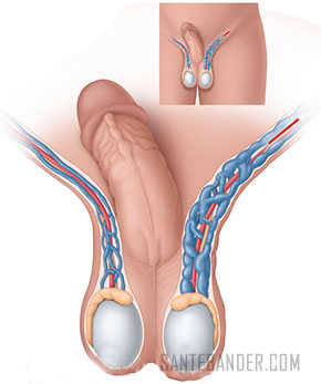 varicocèle et l’infertilité masculine